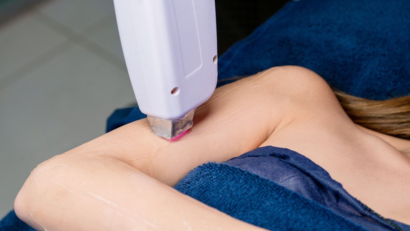 laser hair removal arm laser hair removal